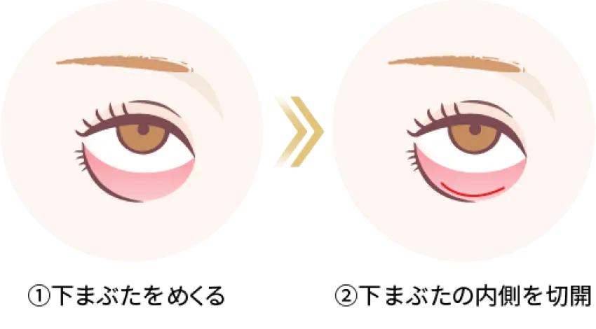 経結膜脱脂法1