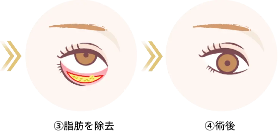 経結膜脱脂法2