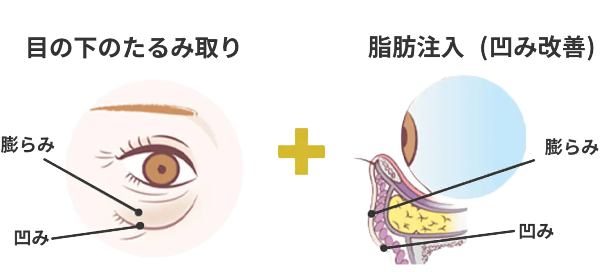 脂肪注入1